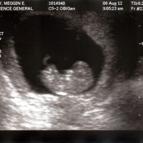 Babby ultrasound.