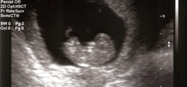 Babby ultrasound.